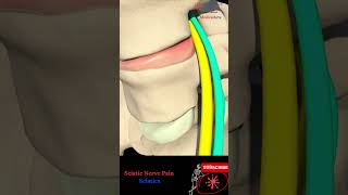 Sciatic nerve pain  Sciatica pathophysiology causes and treatment [upl. by Giah]