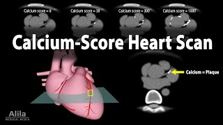 Calcium Score Heart Scan Animation [upl. by Atat]