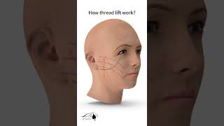 How does thread lift work [upl. by Raddatz]