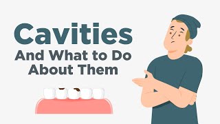 Cavities  Everything You Need to Know [upl. by Athal]