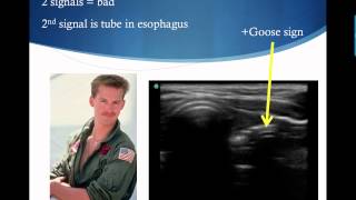 Confirming Endotracheal Tube Placement with Ultrasound [upl. by Tankoos]