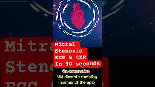 mitralvalve stenosis ecg xray shortnessofbreath cardiology mbbsstudent doctor [upl. by Einohtna379]