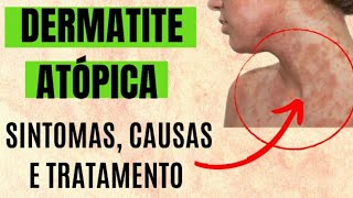 Dermatite Atópica  sintomas causas tratamentos [upl. by Benedetta]