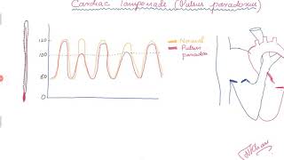 Cardiac Tamponade and Pulsus paradoxus [upl. by Ehrsam]