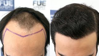 FUE Hair Transplant 3000 Grafts NW III progressing to V by Dr Juan Couto  FUEXPERT CLINIC Spain [upl. by Gnah]