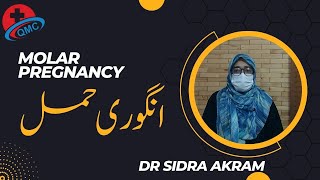 Molar pregnancy انگوری حمل Dr Sidra Akram [upl. by Saloma]