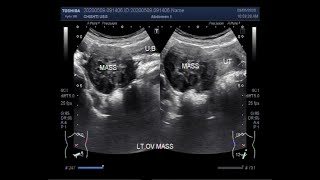 Ultrasound Video showing an Ovarian tumor [upl. by Eeleimaj]