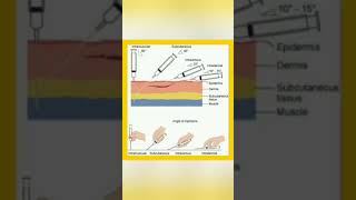 Route  technique of injection administration 💉knowledge easylearning shortsvideo shayari [upl. by Marinna]