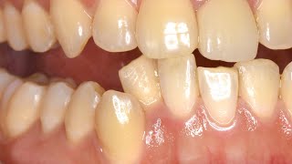 下の歯の高さが違いすぎて咬み合わせがずれている矯正治療 Misaligned teeth and misaligned bite [upl. by Rattan]