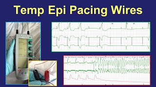 Surgical epicardial pacing wires  uses and management [upl. by Holden]