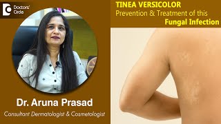 White Patches on Skin Is it TINEA VERSICOLOR  Is it Fungal  DrAruna Prasad  Doctors Circle [upl. by Roarke773]