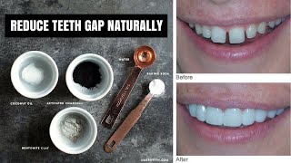 How to fix gaps in teeth naturally at home without using braces Non painful remedies [upl. by Nysila240]