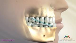 Orthodontic Treatment for Underbite or Crossbite  Carriere Appliance [upl. by Niltyak]