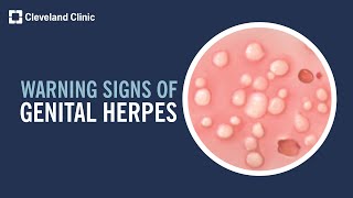 5 Warning Signs of Genital Herpes [upl. by Aitsirhc]