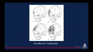 Imaging Characteristics of Hyperostosis Frontalis Interna [upl. by Neda]