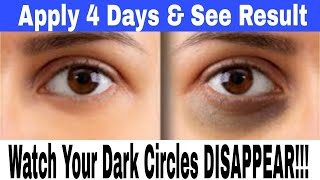 How to Remove Dark Circles Naturally in 4 Days  Home Remedy for Under Eye [upl. by Othella379]