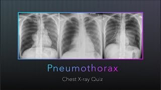 Chest Xray Quiz Pneumothorax [upl. by Aleck839]