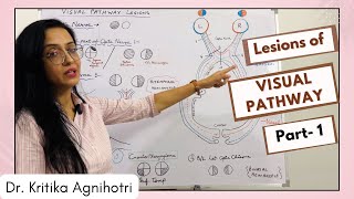 Visual Pathway  Lesions  Part 1 [upl. by Avera]