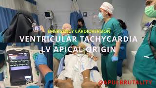 Emergency synchronized cardioversion in ventricular tachycardia VT LV apical origin [upl. by Eellah]