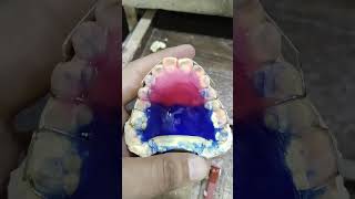 Removable Orthodontic Appliance with Interior Bit planedentalartbyhaider orthodontic appliances [upl. by Kunin]