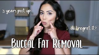 BUCCAL FAT REMOVAL 3 YEAR UPDATE  BEFORE AND AFTER [upl. by Rexanna]