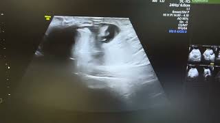 Ultrasound of strangulated umbilical hernia showing omental herniation with fluid [upl. by Haliehs]