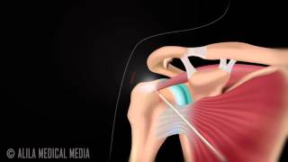 Arthroscopic Subacromial Decompression [upl. by Dnomsaj]