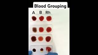 Blood Group Determination kimspatna facts [upl. by Yalcrab]