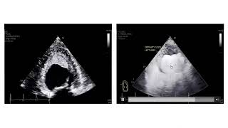 Hypereosinophilic Syndrome Cardiac Diagnosis and Management [upl. by Shandie]