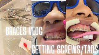 BRACES VLOG  GETTING SCREWS TADS MINI IMPLANTS [upl. by Hennessey777]