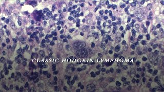 Classic Hodgkin lymphoma [upl. by Arlen]