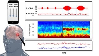 Nexeon MedSystems  Technology for Addressing Parkinsons Disease  3D Medical Animation [upl. by Acima]