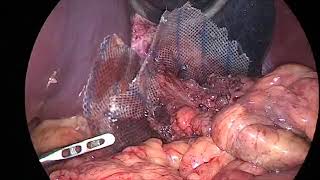 Laparoscopic repair of giant hiatus hernia with composite mesh [upl. by Llehsar349]