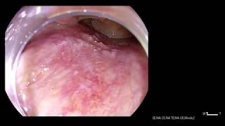 Oropharyngeal Cancer Posterior Wall [upl. by Kean]