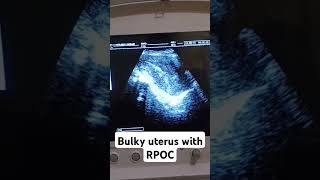 Bulky uterus with RPOCsharevidio shortyoutubevideo [upl. by Tatianas]