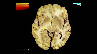 Neurology Exam Cranial nerves I and II [upl. by Fredette722]