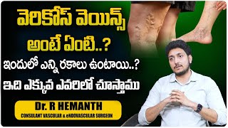 Varicose Veins Stages Diagnosis and New Treatment in Telugu By DrHemanth Kumar  SumanTv [upl. by Begga]