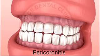 What is Pericoronitis When is Operculectomy Brace Dental Clinics [upl. by Asseram]