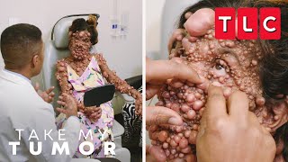 A OneOfAKind Case of Neurofibromatosis  Take My Tumor  TLC [upl. by Aholla]