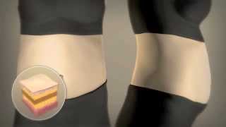 Liposonix  How it Works to Reduce Fat [upl. by Ferdinand]