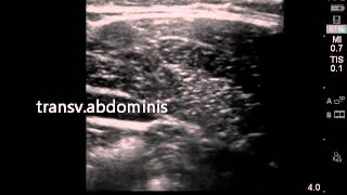 Ultrasound guided transversalis fascia plane block [upl. by Radec654]