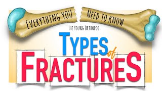 Bone Fracture Types amp Mechanisms  ANIMATION  Fracture classification  The Young Orthopod NEET PG [upl. by Kenley]