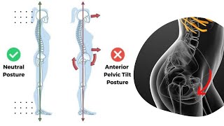 Pelvic Tilt Exercises For Lower Back Pain [upl. by Kciredor]