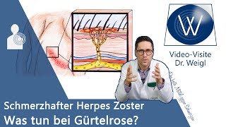 Herpes Zoster Gürtelrose durch WindpockenViren 😬 Schmerzen amp Ausschlag  Entstehung amp Therapie [upl. by Lenora13]