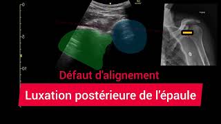 Luxation Postérieure de lÉpaule Échographie Glénohumérale Posterior shoulder dislocation [upl. by Nerred]