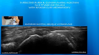 Ultrasound Guided Subdeltoid Bursa Glenohumeral injection in a Female with Rotator Cuff Arthropathy [upl. by Asilanna6]