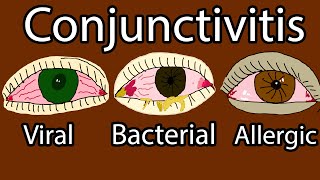 Pink Eye Conjunctivitis  Viral Bacterial and allergic conjunctivitis Symptoms and treatment [upl. by Emsoc]