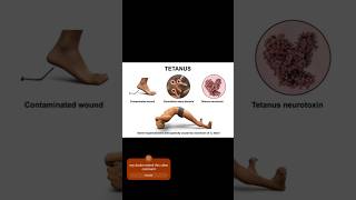 Tetanus causes symptoms treatment treandingshort tetanus [upl. by Elledoj]