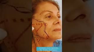 Lifting Facial con cicatrices cortas [upl. by Auhoj1]