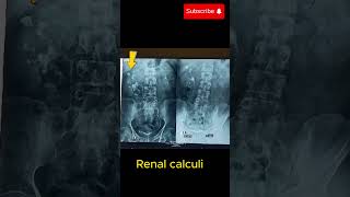 Intravenous urography IVU showing hydronephrosis amp renal calculihydronephrosis renalcalculi [upl. by Yrohcaz]